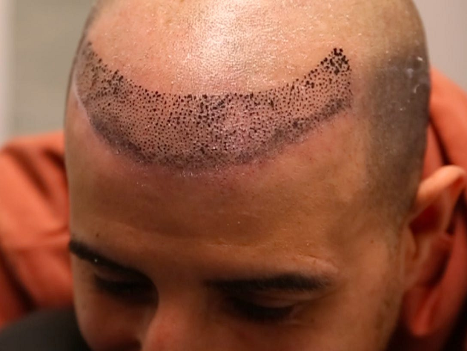 Are Hairline Tattoos Permanent?