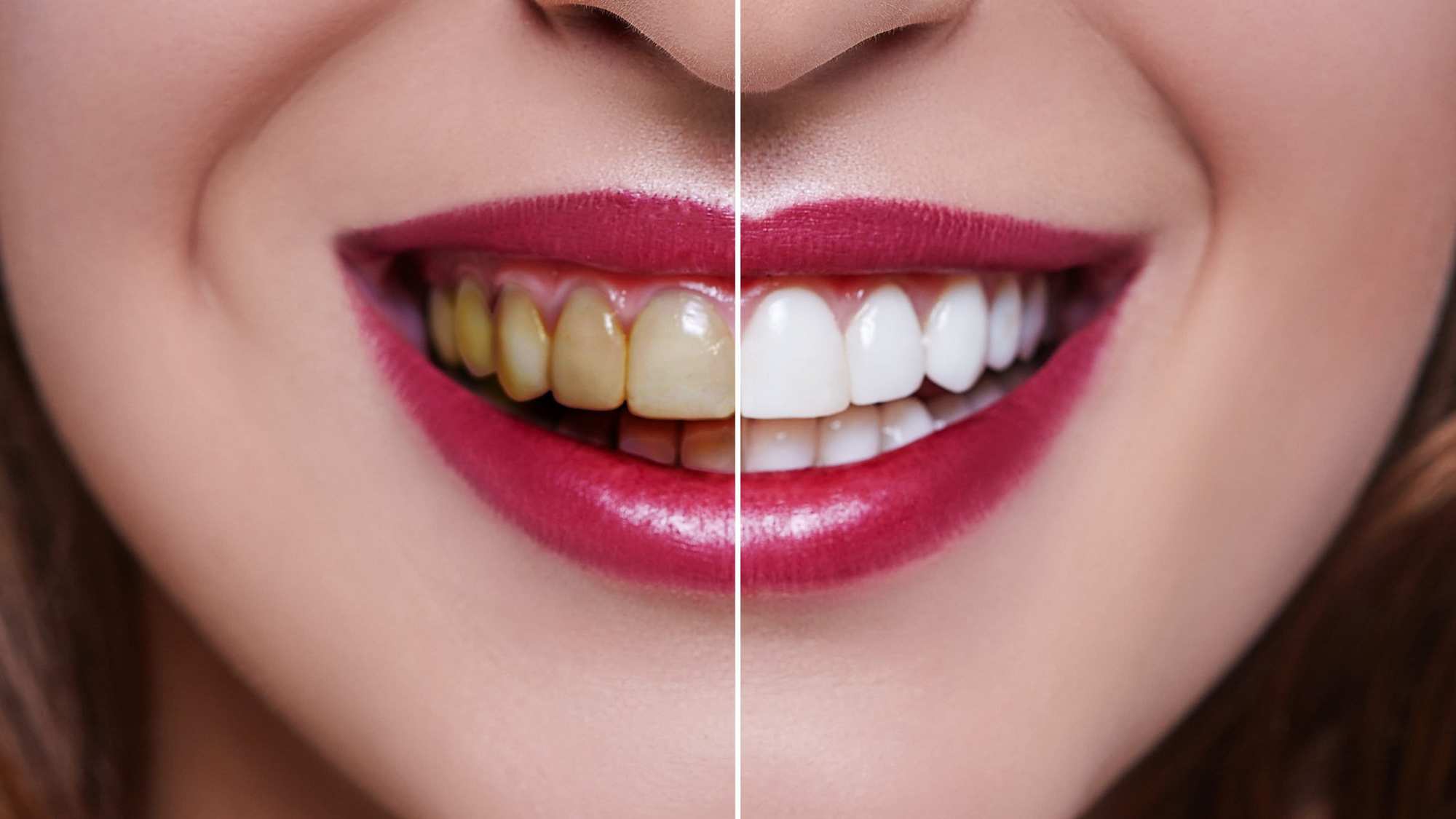 Teeth Whitening: Does it work and is it safe?