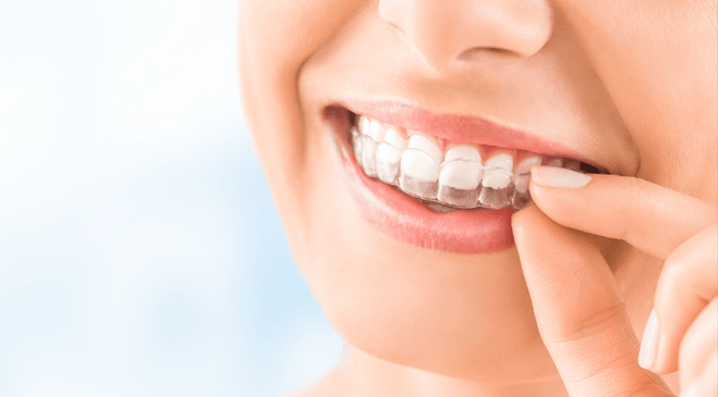 Are You A Good Candidate For Invisalign?