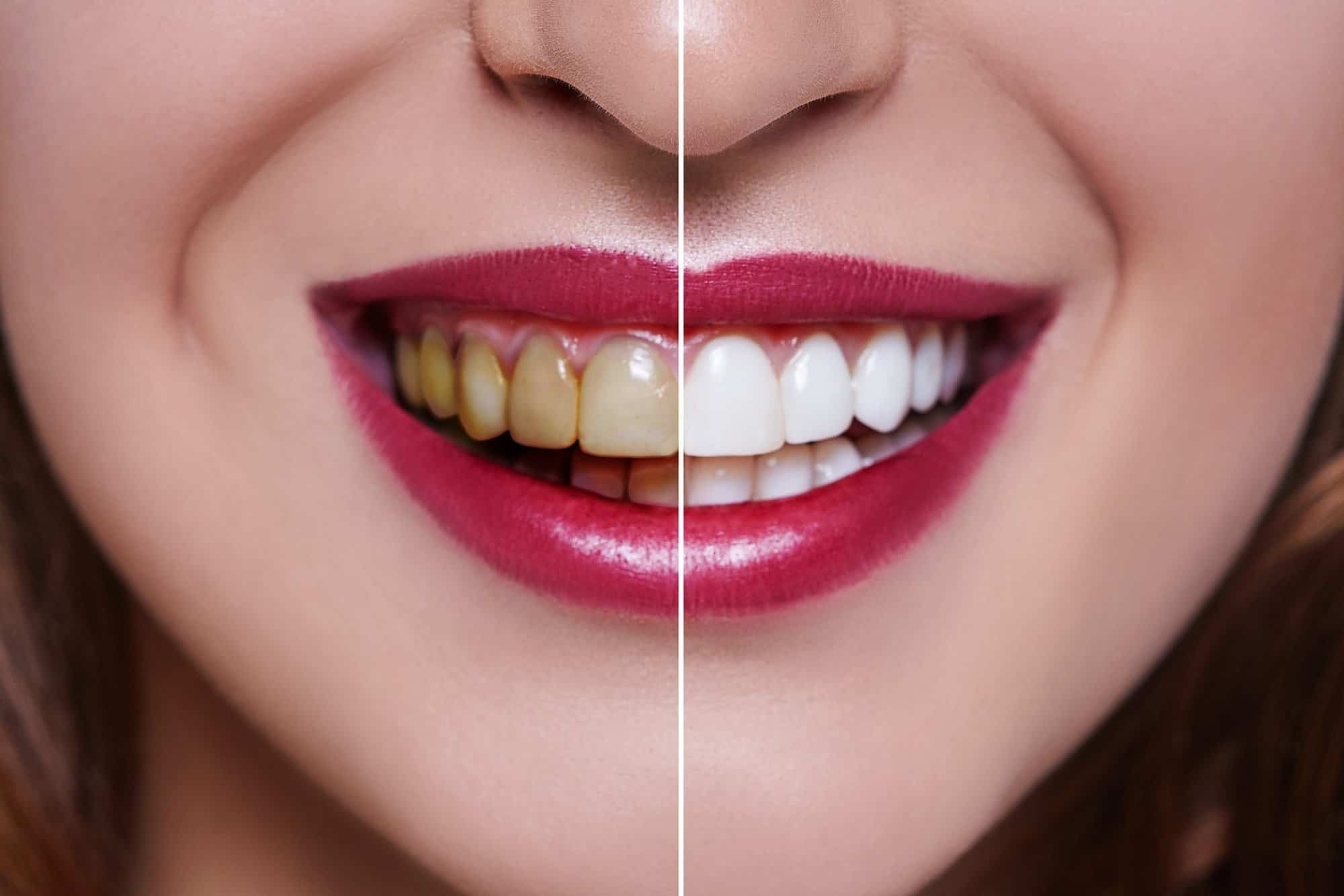How Long Does Professional Teeth Whitening Last?