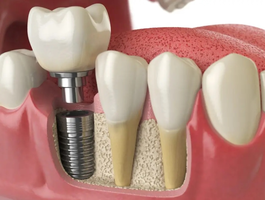 When Is Dental Implant Surgery Needed?
