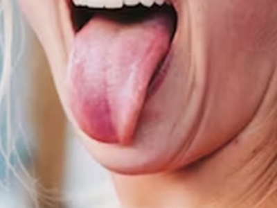 Tongue reconstructed with microvascular surgery in UP hospital