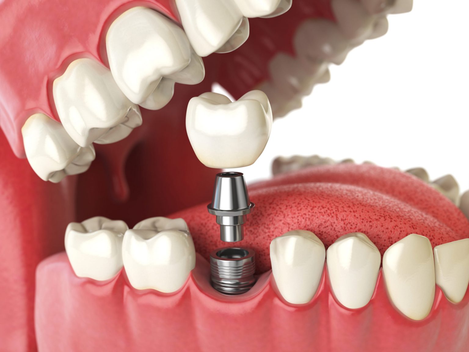What Role Do Osseointegration Play in the Success of Dental Implants?
